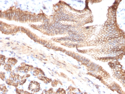 FFPE human pancreatic carcinoma sections stained with 100 ul anti-TROP2 (clone TACSTD2/2151) at 1:300. HIER epitope retrieval prior to staining was performed in 10mM Citrate, pH 6.0.